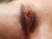 Laceracion en el parpado atendido quirofano movil